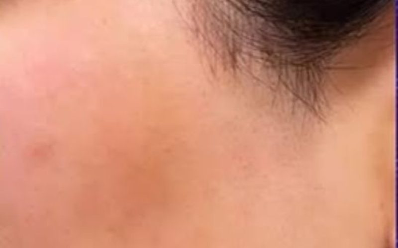 Best laser hair reduction treatment in kalyan (after)