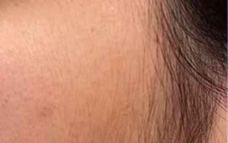 Best laser hair reduction treatment in kalyan (before)
